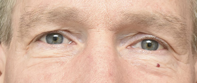 Eyelid Surgery Patient 27 Set 1 Before