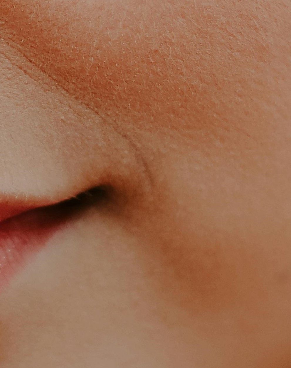 Perioral Mounds: What are They and Why are They So Difficult to Treat?