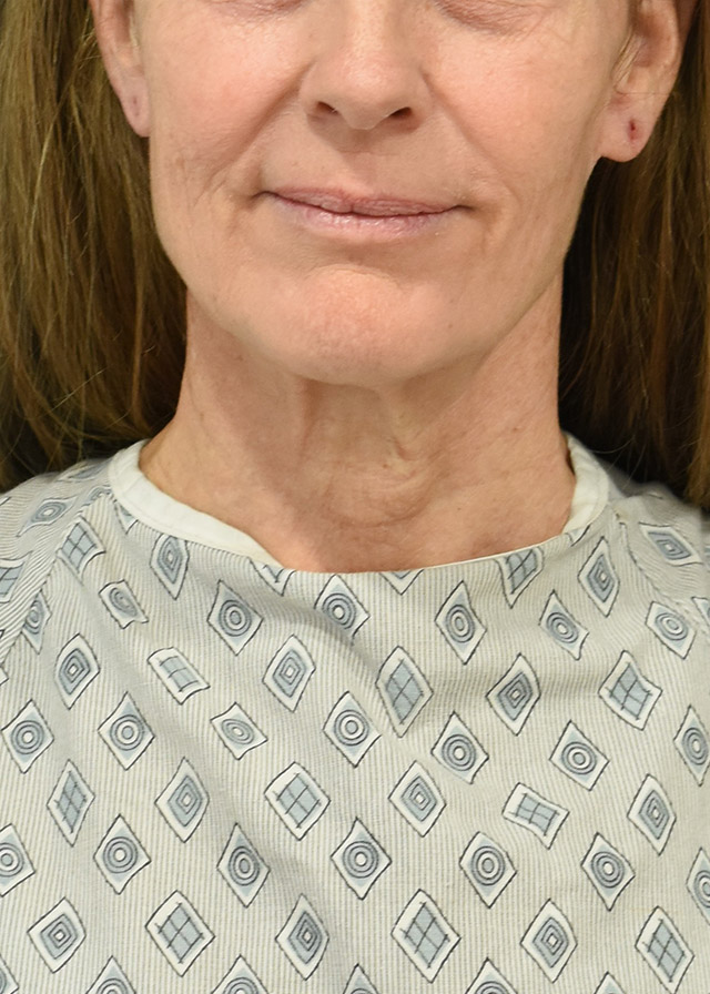 Deep Plane Facelift Patient 40 Set 1 Before