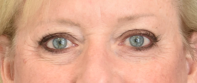 Brow Lift Patient 16 Set 1 After