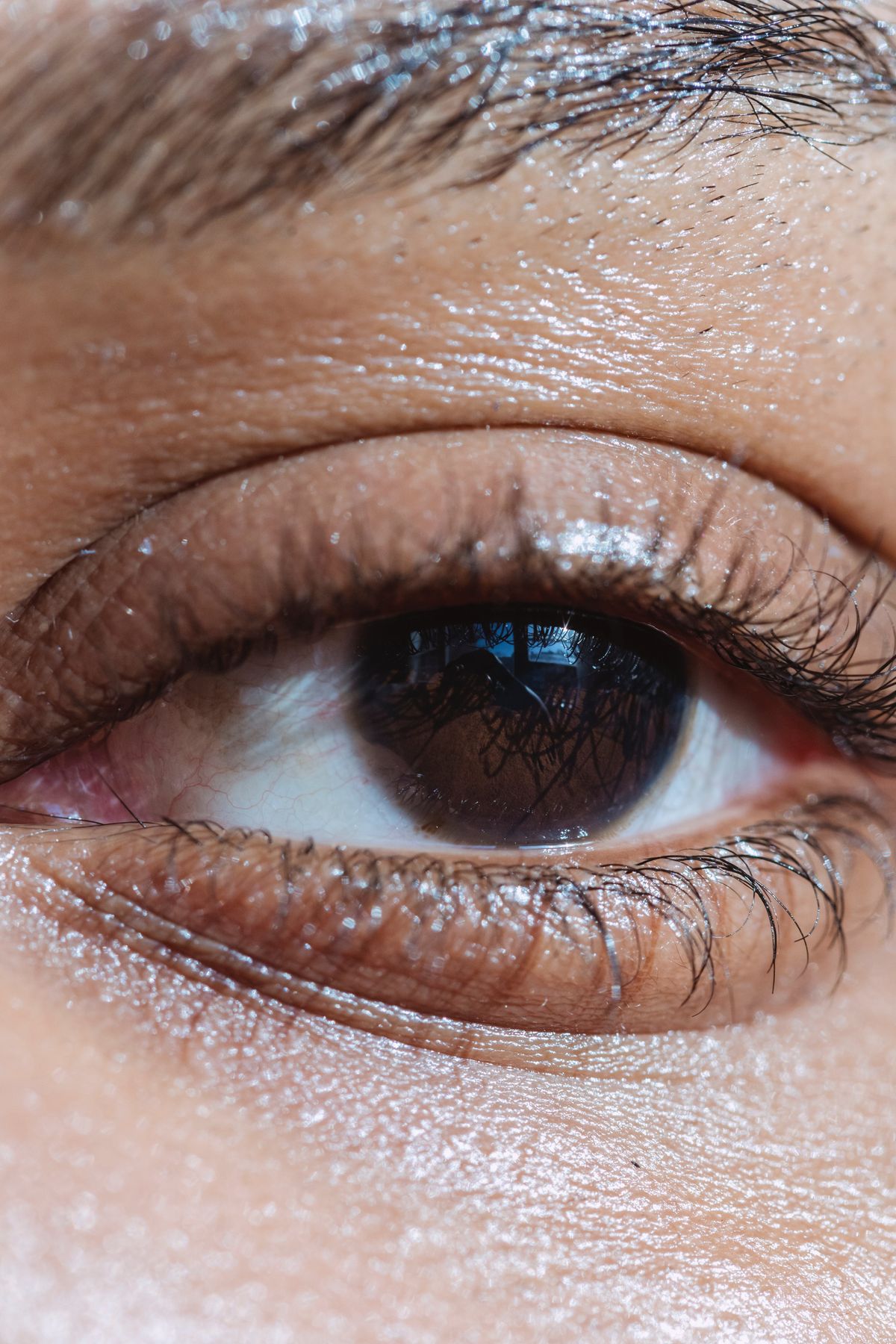 Lower Eyelid Botox© i.e., “Jelly Roll” Botox: Is it Safe and Effective?