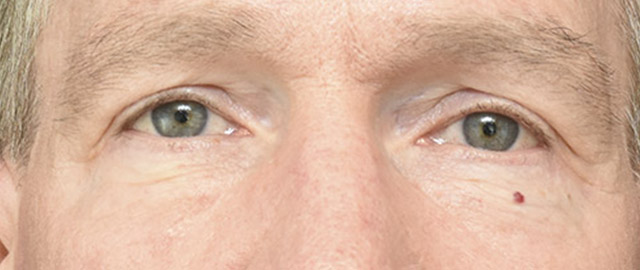 Eyelid Surgery Patient 27 Set 1 After