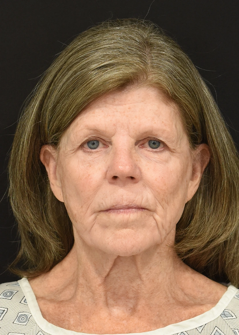 Deep Plane Facelift Patient 29 Set 1 Before